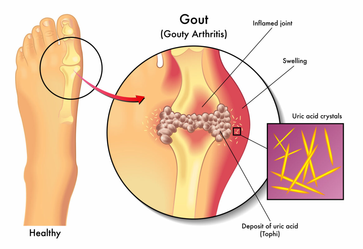 gout disease